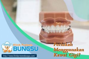 Perlukah Menggunakan Kawat Gigi - Klinik Pratama Bungsu